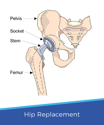 hip replacement surgery india